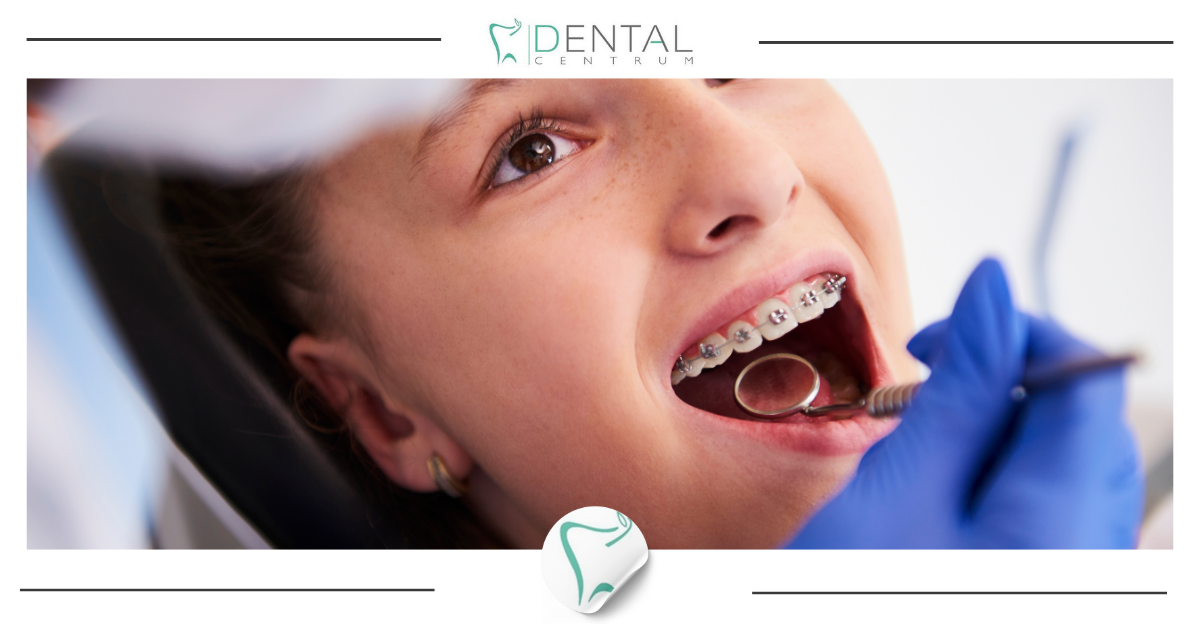 Pielęgnacja zęb&oacute;w dziecka w leczeniu ortodontycznym